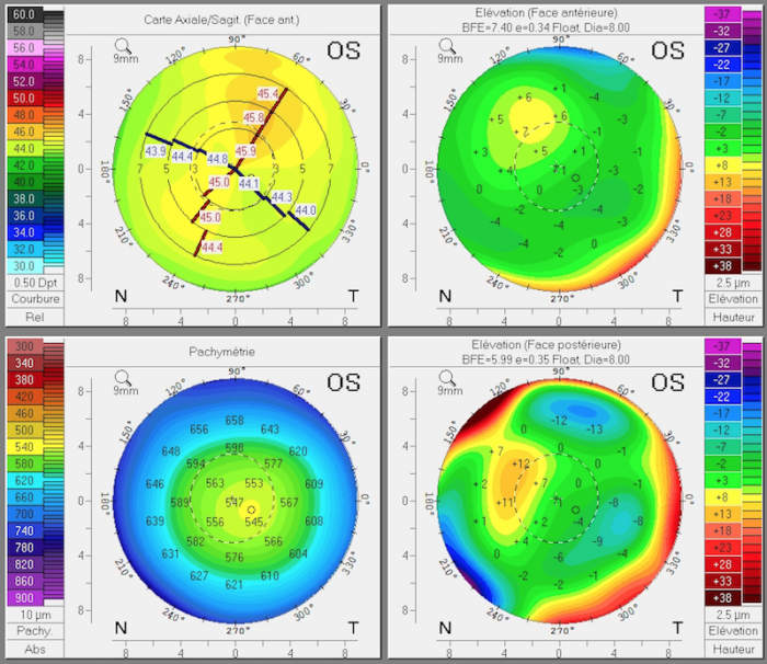 topographie de la cornee avant orthokeratologie